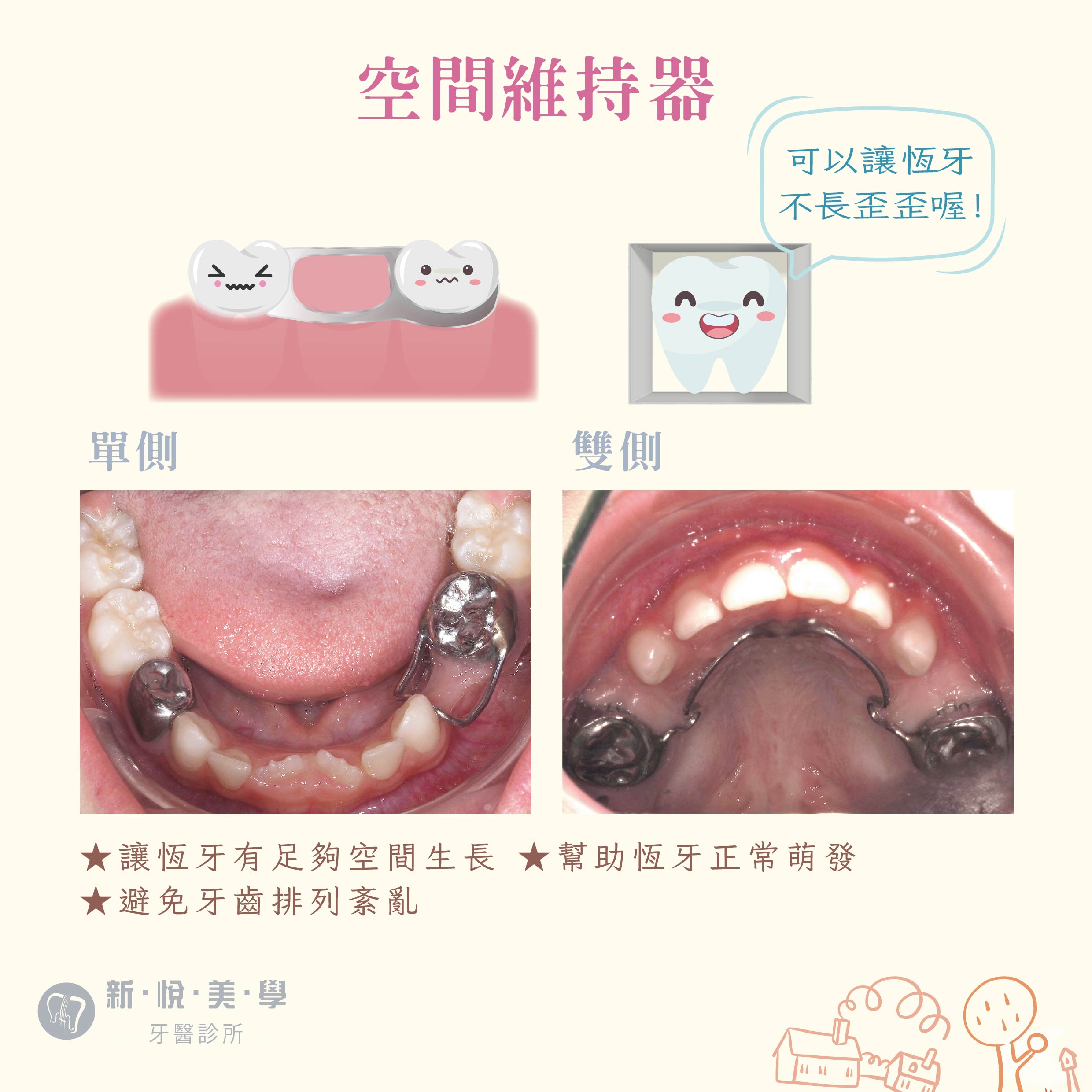 [新悅美學牙醫案例]  我們家寶貝有蛀牙怎麼辦?的第4張圖片